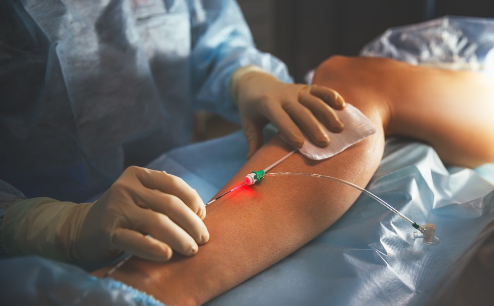 varicose-veins-surgery